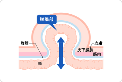 鼠径ヘルニアとは？