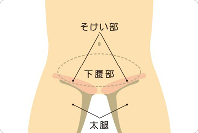 鼠径ヘルニアの種類