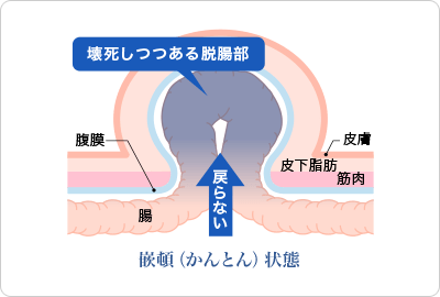 注意すべき『嵌頓(かんとん)』とは