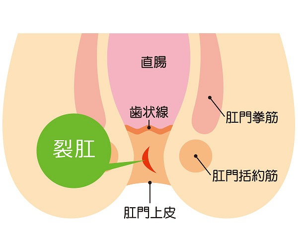 切れ痔