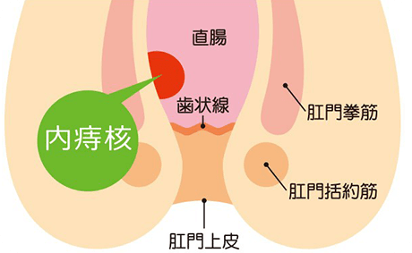 いぼ痔（痔核）