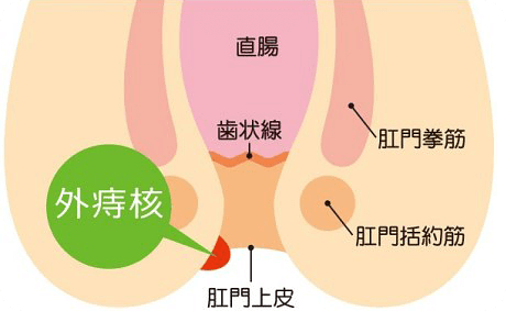 外痔核について