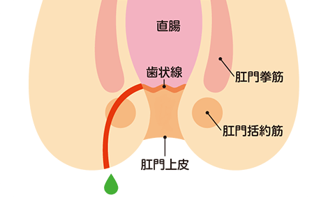 痔ろう（穴痔）