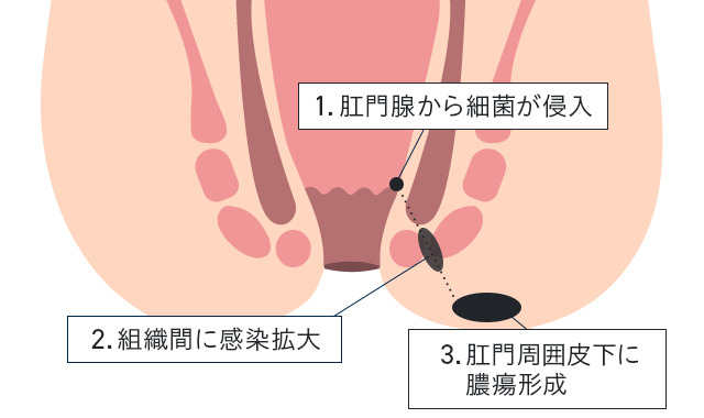 肛門周囲膿瘍