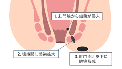 肛門周囲膿瘍とは