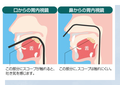 嘔吐反射のない経鼻内視鏡