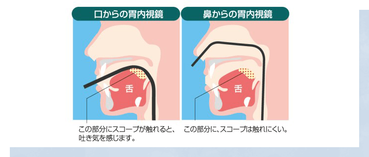 嘔吐反射のない経鼻内視鏡