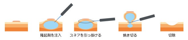 コールドポリペクトミー