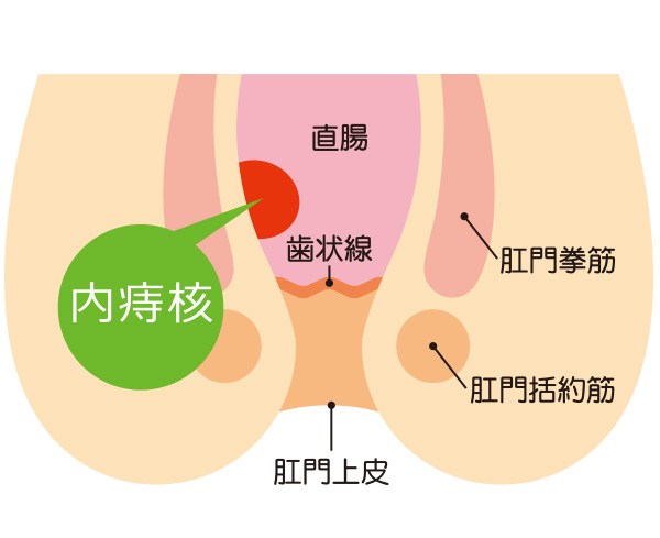 いぼ痔(痔核)